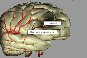 Лікування хронічної ішемії головного мозку (головного) Лікування хронічної ішемії головного мозку