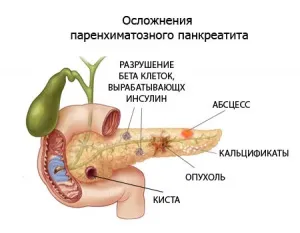 Лікування кісти підшлункової залози народними засобами (народними) Лікування кісти підшлункової залози народними засобами