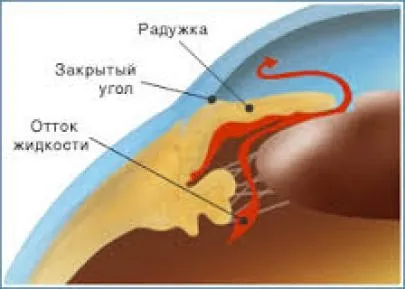 Лікування глаукоми народними способами, правила здоров'я і довголіття (причини глаукоми) Лікування глаукоми народними способами, правила здоров'я і довголіття