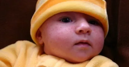 Лікування акне у новонародженої дитини, немовляти, підлітка (дитини) Лікування акне у новонародженої дитини, немовляти, підлітка