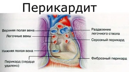 Лікування перикардиту серця препарати, які найефективніші (препарати) Лікування перикардиту серця препарати, які найефективніші