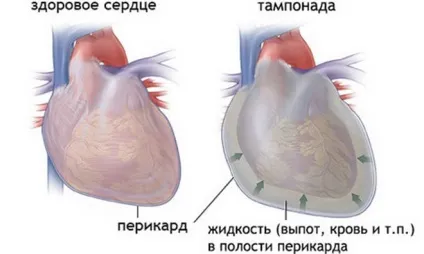 Лікування перикардиту серця препарати, які найефективніші (активних речовин цих) Лікування перикардиту серця препарати, які найефективніші