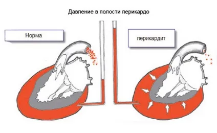 Лікування перикардиту серця препарати, які найефективніші (активних речовин цих препаратів) Лікування перикардиту серця препарати, які найефективніші