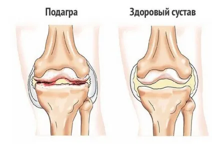 Лікування подагри йодом і аспірином рецепти (рецепти) Лікування подагри йодом і аспірином рецепти