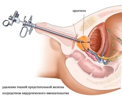 Лікування аденоми простати операція з видалення лазером (лазером) Лікування аденоми простати операція з видалення лазером