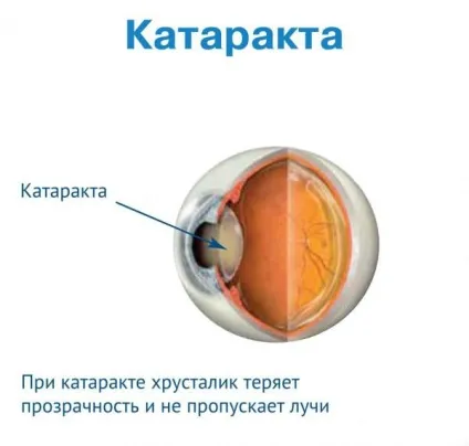 Лікування катаракти без операції лікарськими засобами відгуки, симптоми, лікування, профілактика, у (операції) Лікування катаракти без операції лікарськими засобами відгуки, симптоми, лікування, профілактика, у