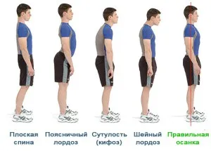 Лордоз поперекового відділу хребта вправи, лікування