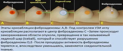 Листоподібна фіброаденома молочної залози що це таке, симптоми і лікування у жінок (фіброаденома) Листоподібна фіброаденома молочної залози що це таке, симптоми і лікування у жінок