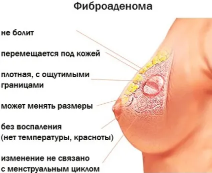 Листоподібна фіброаденома молочної залози що це таке, симптоми і лікування у жінок (молочної) Листоподібна фіброаденома молочної залози що це таке, симптоми і лікування у жінок