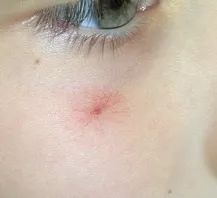 Складки під очима причини і як прибрати (хвороби) Складки під очима причини і як прибрати