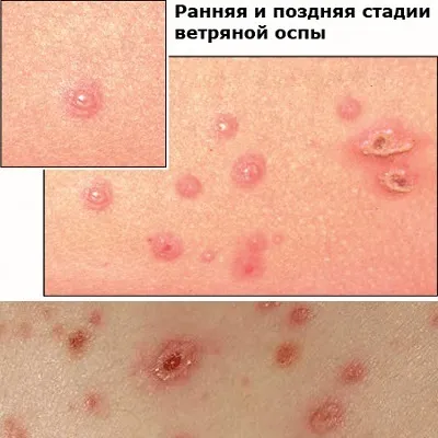 Скільки днів тримається вітрянка у дітей, вітрянка у дітей (тримається) Скільки днів тримається вітрянка у дітей, вітрянка у дітей