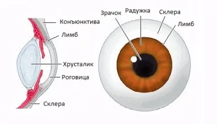 Склерит (запалення склери ока) причини, симптоми, лікування (краплі, народні засоби і інше) і (очі) Склерит (запалення склери ока) причини, симптоми, лікування (краплі, народні засоби і інше) і