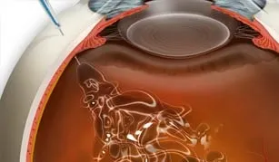 Міжнародний офтальмологічний центр (макулярної дегенерації сітківки) Міжнародний офтальмологічний центр