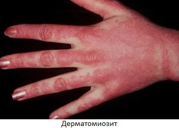 Міозит що це таке, симптоми, лікування запалення м'язів (біль м'яз) Міозит що це таке, симптоми, лікування запалення м'язів