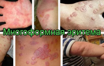 Багатоформна еритема шкіри - причини і лікування, лікування в домашніх умовах (причини) Багатоформна еритема шкіри - причини і лікування, лікування в домашніх умовах