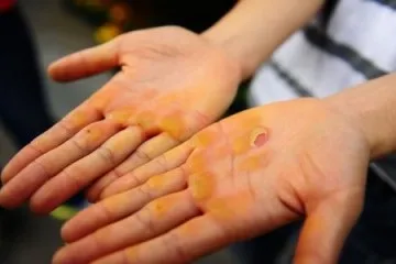 Мозолі на руках як швидко вивести сухі освіти (вивести) Мозолі на руках як швидко вивести сухі освіти