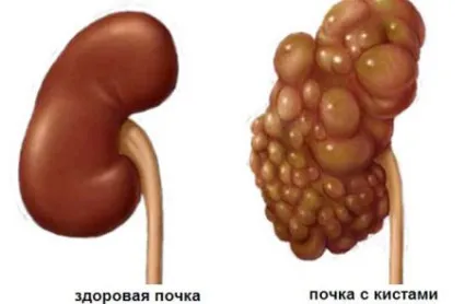 Мультікістоз нирок у плода та новонародженого (Мультікістозная дисплазія) (мультікістоз) Мультікістоз нирок у плода та новонародженого (Мультікістозная дисплазія)