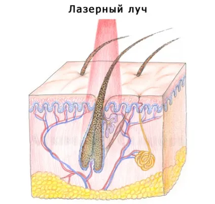 Чи можна засмагати після лазерної епіляції (епіляції) Чи можна засмагати після лазерної епіляції