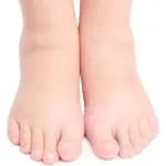 М'які мозолі між пальцями на ногах причини і як позбутися в домашніх умовах, все про ногах (м'які) М'які мозолі між пальцями на ногах причини і як позбутися в домашніх умовах, все про ногах