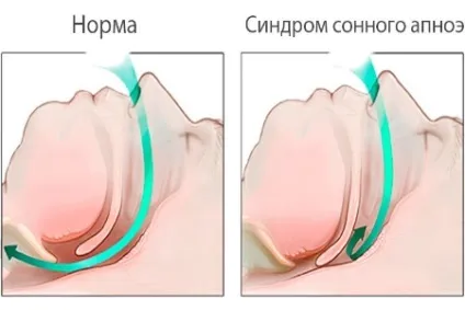 Порушення венозного відтоку головного мозку симптоми і лікування (відтоку) Порушення венозного відтоку головного мозку симптоми і лікування