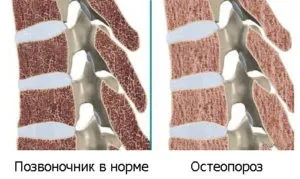 Неврит плечового нерва симптоми і лікування (симптоми) Неврит плечового нерва симптоми і лікування