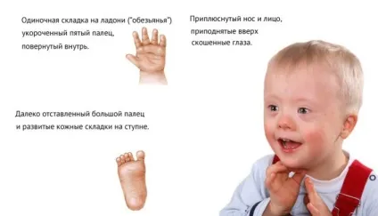 Олігофренія класифікація (ступеня, форми олігофренії), симптоми, причини, лікування, особливості (форми) Олігофренія класифікація (ступеня, форми олігофренії), симптоми, причини, лікування, особливості