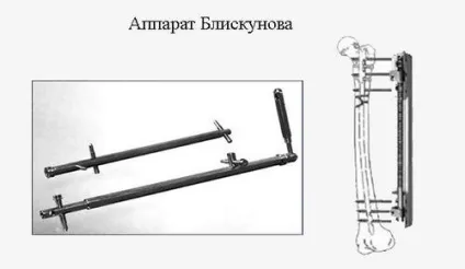 Операція по подовженню ніг апаратом Ілізарова (подовження) Операція по подовженню ніг апаратом Ілізарова