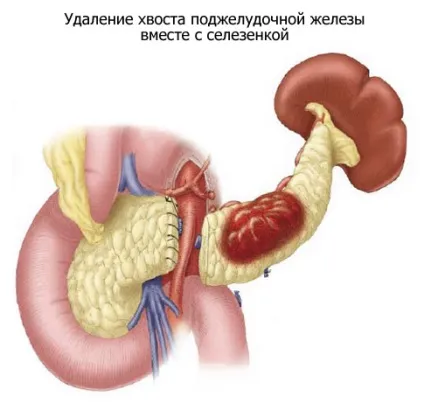 Операції на підшлунковій залозі (операція) Операції на підшлунковій залозі