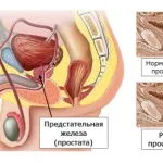Пухлина простати у чоловіків прогноз, симптоми і лікування (простати) Пухлина простати у чоловіків прогноз, симптоми і лікування