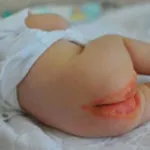 Попрілості від пелюшок у дітей - що робити так само на тілі, на шиї у грудничка (дітей) Попрілості від пелюшок у дітей - що робити так само на тілі, на шиї у грудничка