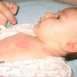 Попрілості від пелюшок у дітей - що робити так само на тілі, на шиї у грудничка (попрілості) Попрілості від пелюшок у дітей - що робити так само на тілі, на шиї у грудничка