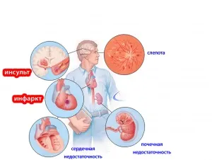 Органи-мішені при гіпертонії що робити при ураженні