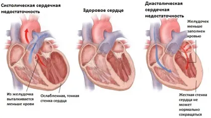 Органи мішені при гіпертонічній хворобі - визначення діагнозу (хвороби) Органи мішені при гіпертонічній хворобі - визначення діагнозу