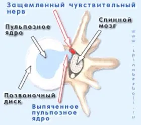 Особливості фітнес тренування при грижі міжхребцевого я бабидова євгенія (фітнес) Особливості фітнес тренування при грижі міжхребцевого я бабидова євгенія