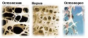 Остеопенія що це таке і як лікувати цю хворобу кісток скелета в молодому віці і зрілому (скелета) Остеопенія що це таке і як лікувати цю хворобу кісток скелета в молодому віці і зрілому
