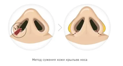 Набряк носа після ринопластики, фото лікування (лікування) Набряк носа після ринопластики, фото лікування