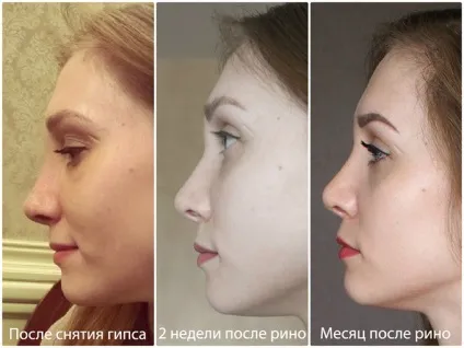 Набряк після ринопластики причини появи, профілактика, як прибрати, фото по днях (набряк) Набряк після ринопластики причини появи, профілактика, як прибрати, фото по днях