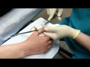 Панариций причини недуги, ознаки, ускладнення, лікування (скупчення гною) Панариций причини недуги, ознаки, ускладнення, лікування