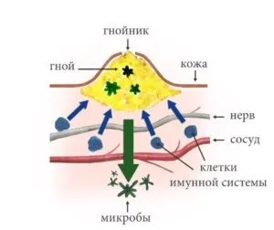 Панариций на нозі причини, симптоми, лікування, ускладнення