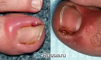 Панариций на нозі лікування - gtsf