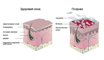 Відмінність екземи від псоріазу як розпізнати хворобу по проявах, в чому різниця між двома (проявів) Відмінність екземи від псоріазу як розпізнати хворобу по проявах, в чому різниця між двома