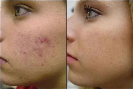 Звідки береться акне і як його лікувати більше ніяких міфів! (Акне) Звідки береться акне і як його лікувати більше ніяких міфів!