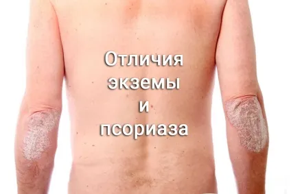 Відмінності екземи та псоріазу подібності, причини, і особливості (причини) Відмінності екземи та псоріазу подібності, причини, і особливості