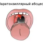 Паратонзиллит симптоми, лікування і фото абсцесу горла (симптоми) Паратонзиллит симптоми, лікування і фото абсцесу горла