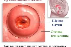 Папілома небезпечна