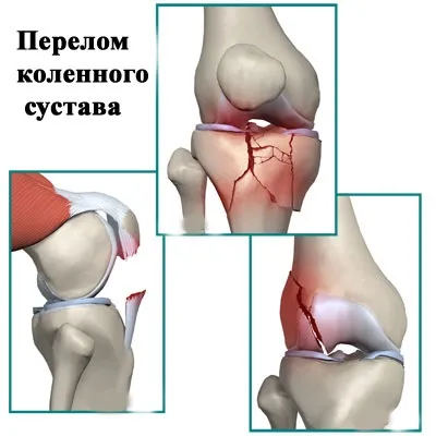 Перелом колінного суглоба лікування, симптоми, реабілітація (лікування) Перелом колінного суглоба лікування, симптоми, реабілітація