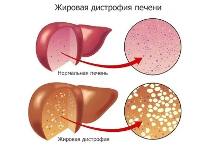 Печінка алкоголіка і здорової людини фото печінки питущого (алкоголіка) Печінка алкоголіка і здорової людини фото печінки питущого