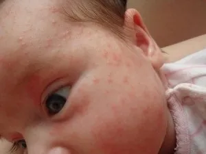 Чому з'являється висип на обличчі у дитини 1 місяць дрібна, алергічний висип (висип на обличчі у дитини 1 місяць) Чому з'являється висип на обличчі у дитини 1 місяць дрібна, алергічний висип