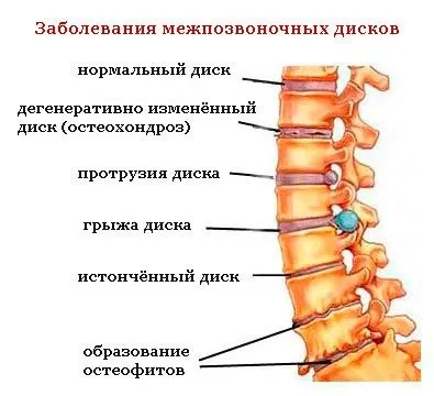 Чому ниє поперек у жінок причини, лікування, феломена (лікування) Чому ниє поперек у жінок причини, лікування, феломена