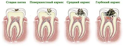 Чому від карієсу не знайшли діючі ліки (карієсу) Чому від карієсу не знайшли діючі ліки